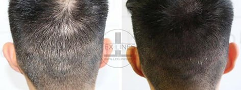 Haarpigmentierung in Ludwigsburg und Stuttgart, optische Haardichte für Männer und Frauen