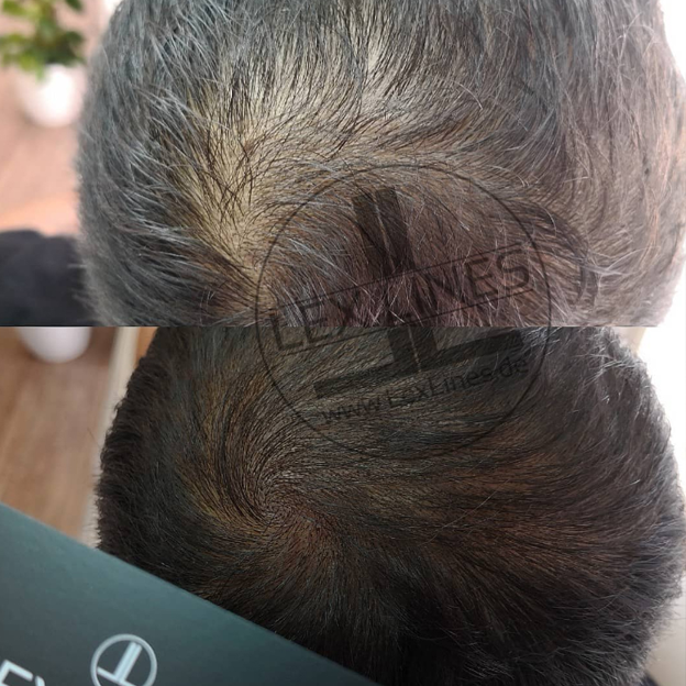 Haarpigmentierung_Ludwigsburg