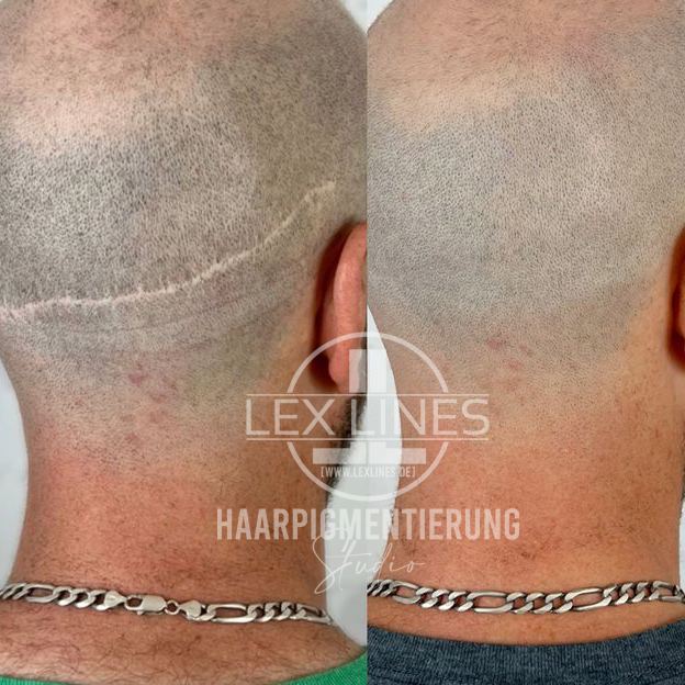 Haarpigmentierung_Narben